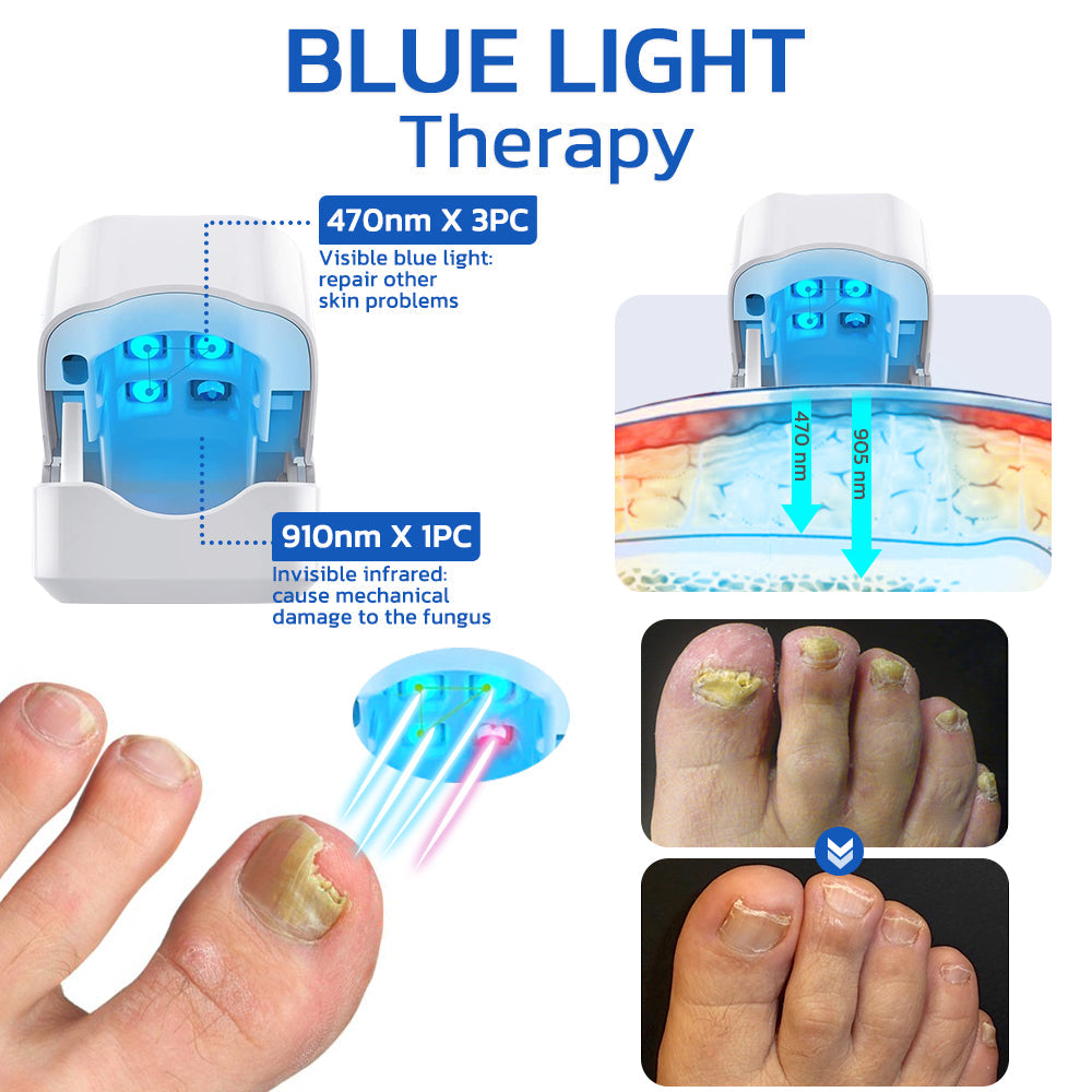 IKeener Nail Fungus Laser 905Nm Phototherapy Paronychia Foot Paronychia  Foot Care Home Phototherapy Paronychia Mini Toenail Onychomycosis Therapy  Led Cure - Walmart.com